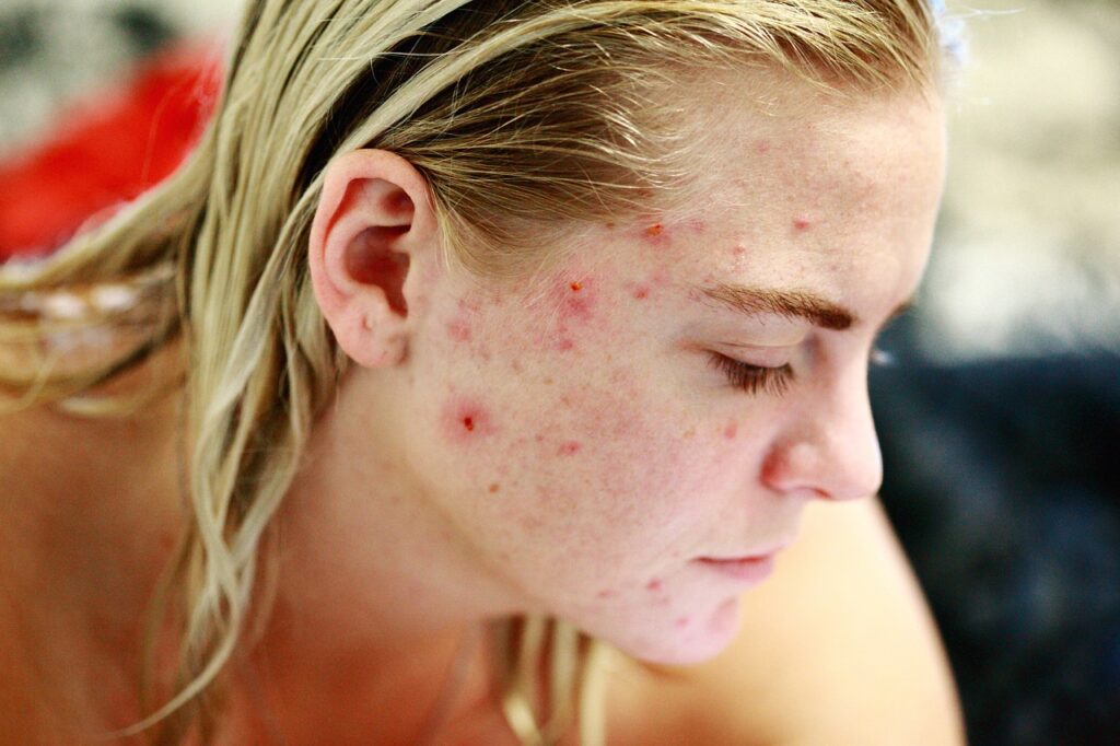 A maioria das pessoas sofrem ou já sofreram dessa condição em algum momento da vida, se não é o seu caso, sinta-se privilegiado. A Acne é caracterizada por ser uma doença inflamatória da pele que leva ao aparecimento de comedões (cravos), pústulas (espinhas), nódulos e abscessos. A demora no seu tratamento pode resultar em cicatrizes e manchas na pele que são sempre um desafio estético para o Dermatologista. Os tratamentos da Acne variam desde produtos de skincare, ácidos, antibióticos até ao uso da Isotretinoína, o famoso Roacutan (nome comercial da substância). Após o controle da doença ativa, iniciamos os tratamentos das marcas que ficaram na pele. Procure logo ajuda para diminuir as chances de ter cicatrizes e manchas no futuro. Conte comigo nessa jornada! 